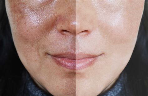 What is the Fastest Way to Cure Melasma? - Makeup Analysis