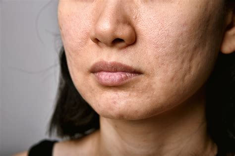 At What Age Does Acne Go Away?