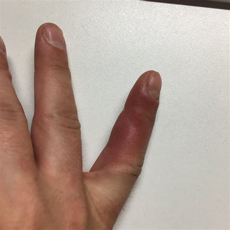 Burst Blood Vessel In Finger Images Blood Blisters: Causes, Diagnosis,