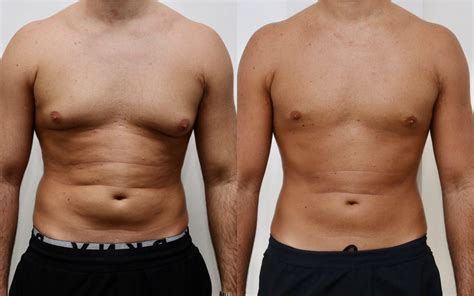 Gynecomastia Surgery | Male Breast Reduction Edinburgh