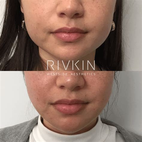Non Surgical Jaw Reduction - RIVKIN Aesthetics