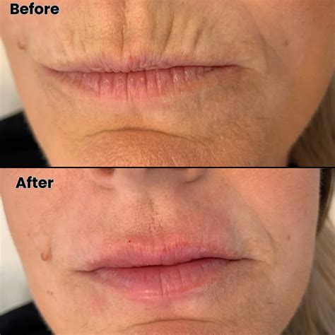 Botox Lip Lines, Smoker lines Ogden Utah