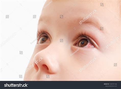 Red Spot On Baby's Eye