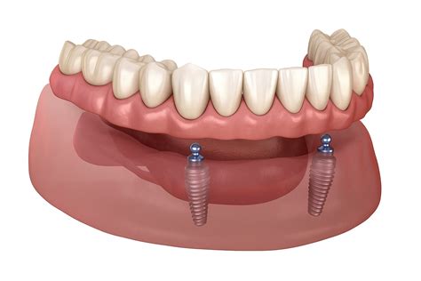 Smiles R Us Dentistry - Implant Retained Dentures