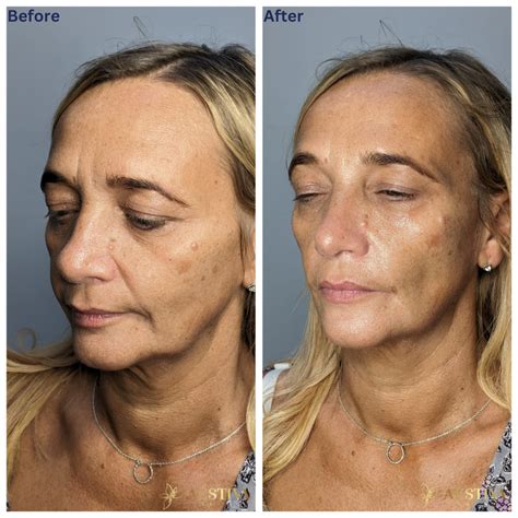Nose to Mouth lines (Nasolabial Folds) - Aestiva Clinic