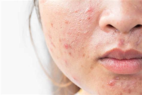 Acne Dark Spots On Face