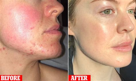 Cystic Acne Scars
