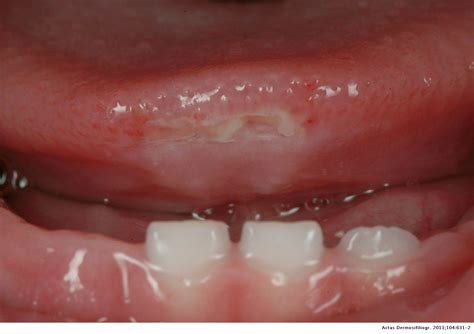 Ulcer Under Tongue