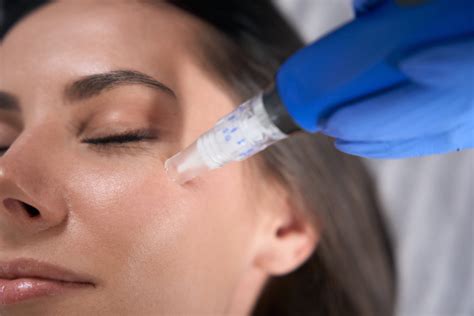 How Much Does SkinPen Microneedling Cost? - Gold Coast Aesthetics