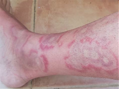 Mycoplasma Pneumonia Rash