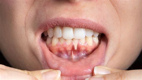 Trench Mouth: Symptoms and Assessment by Li Family Dental