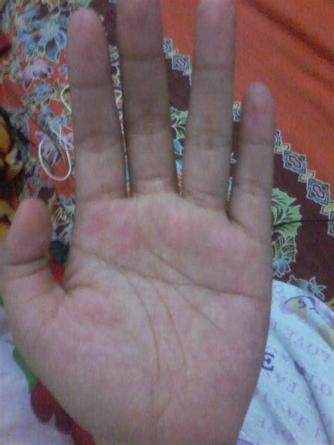 Single palmar crease: how to recognize simian lines?