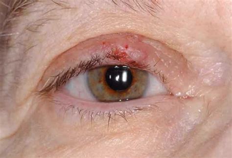 Sebaceous Cyst Eyelid at Kate Wylde blog
