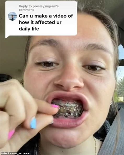 Wiring My Jaw Shut at Linda Daniel blog