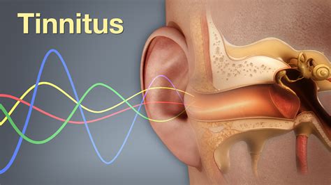 Tinnitus shown and explained using medical animation still shot