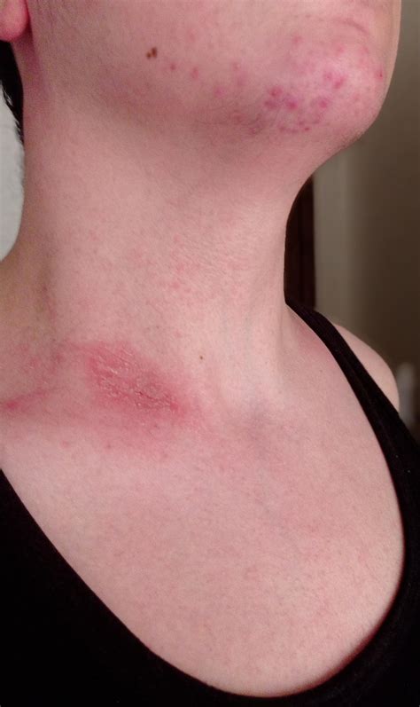red itchy scaly spot on my neck : r/DermatologyQuestions