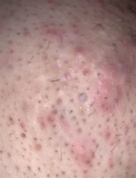 Prevent Ingrown Hairs Bikini Area After Waxing at Joan Bowler blog