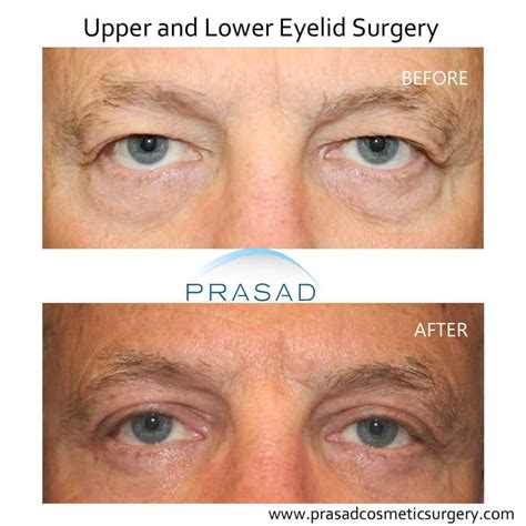 Hooded Eyelid Surgery: Results and Recovery