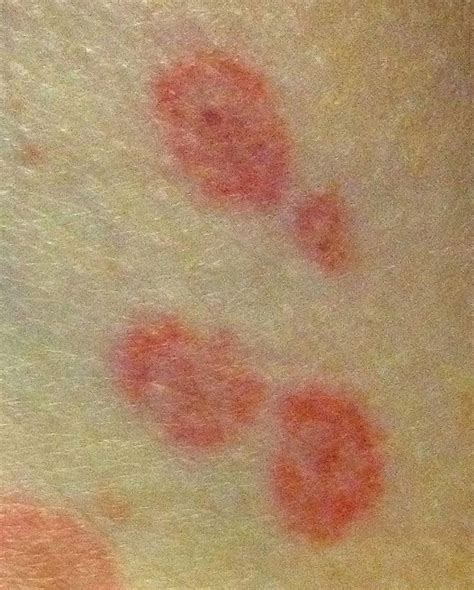 Stevens Johnson Syndrome Mild Rash