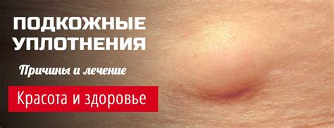 Подкожное уплотнение: шарик, бугорок, шишка. Причины и лечение в ...