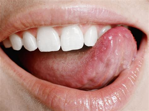 Small, Big, Sore Red Spots on Tongue Cause & Meaning - American Celiac