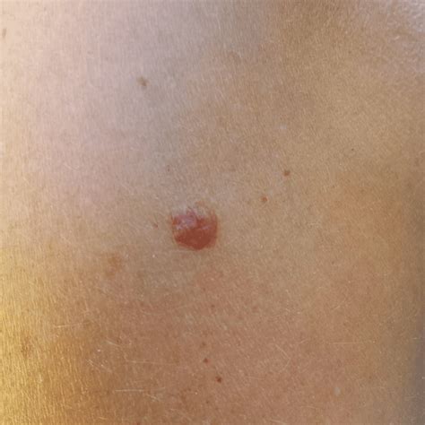 Effective Seborrheic Keratoses Removal in Montreal