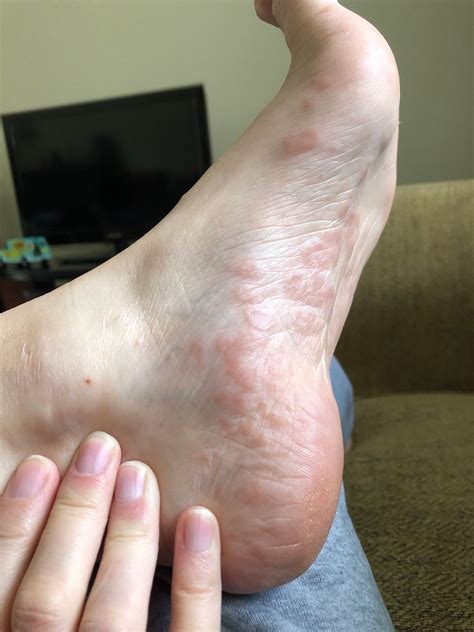 Itchy Clear Bumps On Foot Clearance | emergencydentistry.com