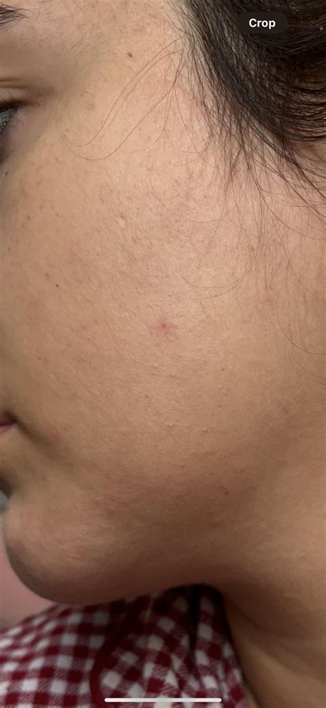 Red dot on face, should I be concerned? : r/DermatologyQuestions