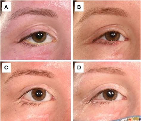 Lower eyelid lengthening in facial nerve palsy: when is a periosteal flap required? | British ...