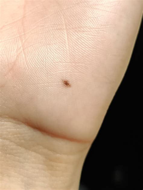 is this a freckle? it appeared on the palm of my hand 3 years ago and is growing very very ...