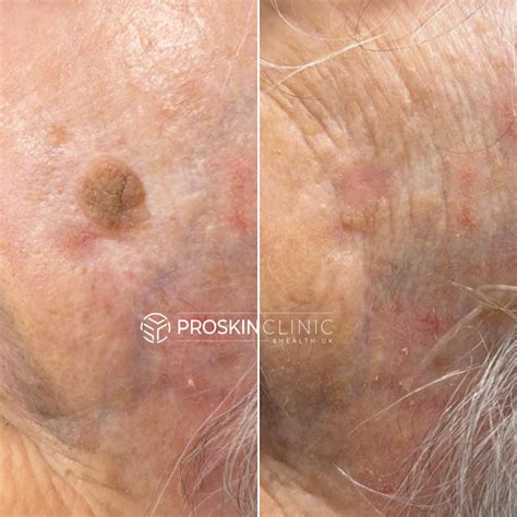 Seborrheic Keratosis Removal Gloucester - ProSkin Clinic & Health