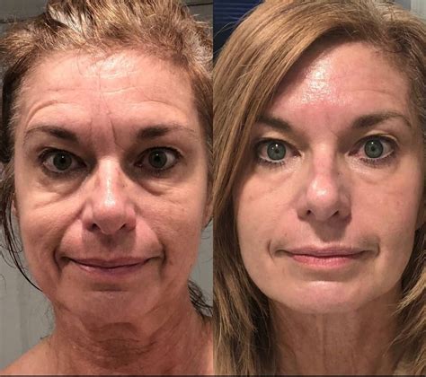 HIFU/Radio Frequency | Radio frequency skin tightening, Tighten facial skin, Anti aging procedures