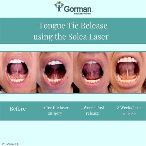 Before and After Photos - Tongue Tie Life