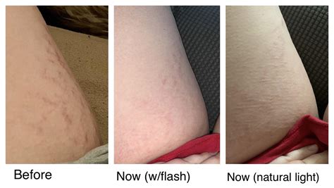 Legs And Thighs Stretch Marks at Lee Ramirez blog