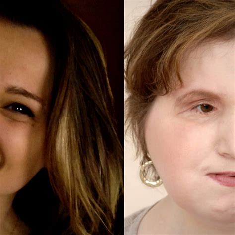 The amazing story of Katie Stubblefield: She became the youngest person to receive a face ...