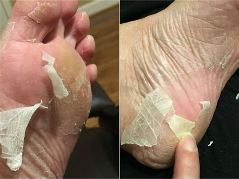 Why Do Feet Randomly Peel at Alana Vineyard blog