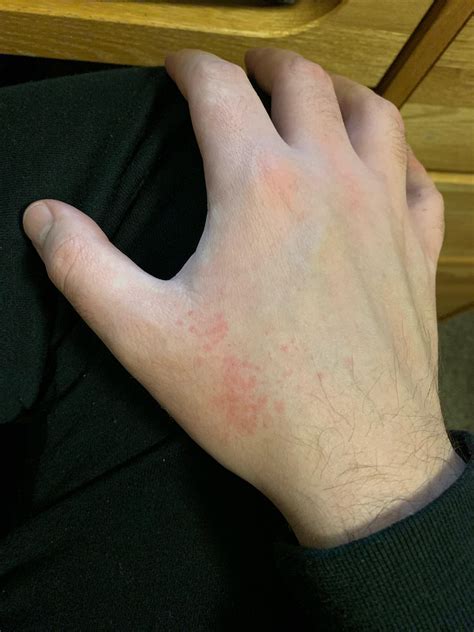 These red spots randomly appear on my hand. They are not raised, and ...