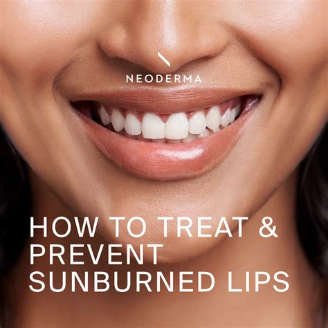 How to Treat and Prevent Sunburned Lips – NEODERMA
