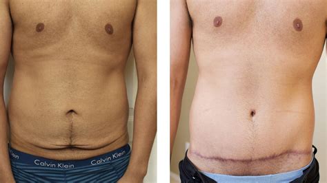 Excess Skin Removal Surgery