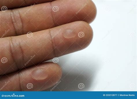 Blisters on the Tip of the Ring Finger and Little Finger Stock Image ...