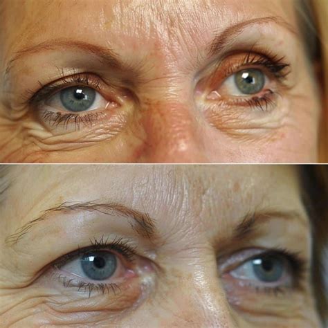 Stunning Transformation: Discover the Remarkable Results of Botox Eyebrow Lift Before and After.