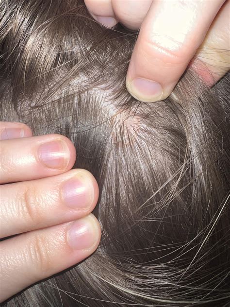 2 moles? On scalp : r/Melanoma
