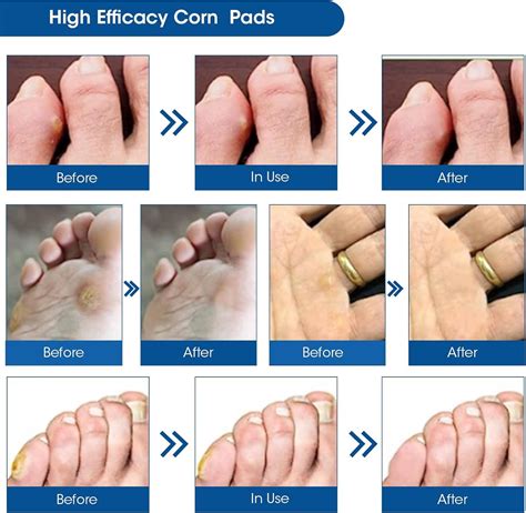 Corn Remover Pads - 42 Pcs Wart & Foot Corn Removal Patches for Pain ...