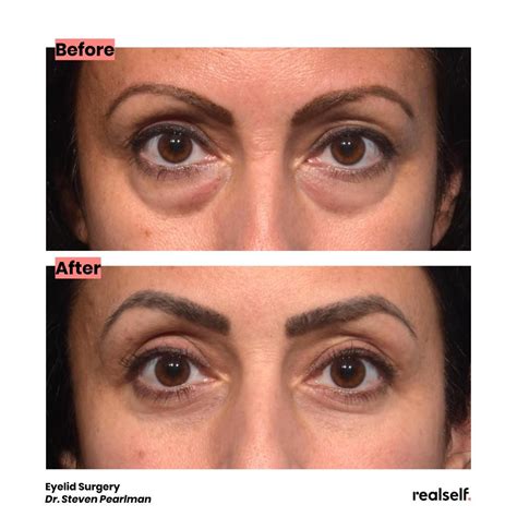 Hooded eye surgery – Artofit