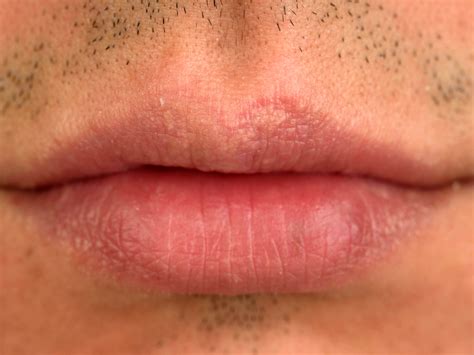 Fordyce Spots On Lips Treatments | Lipstutorial.org