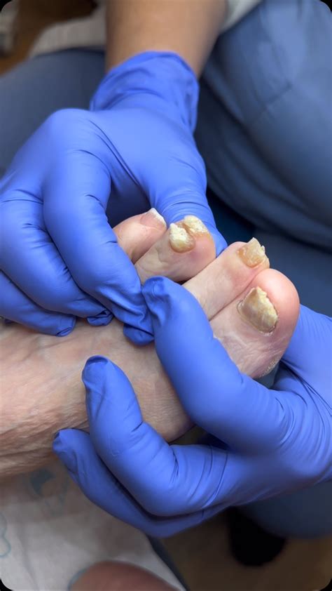 Medi Pedi NYC | Safe & Painless Foot Care | Prioritizing foot health ...