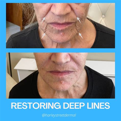 Marionette Lines Treatment in London | Harley Street Dermal