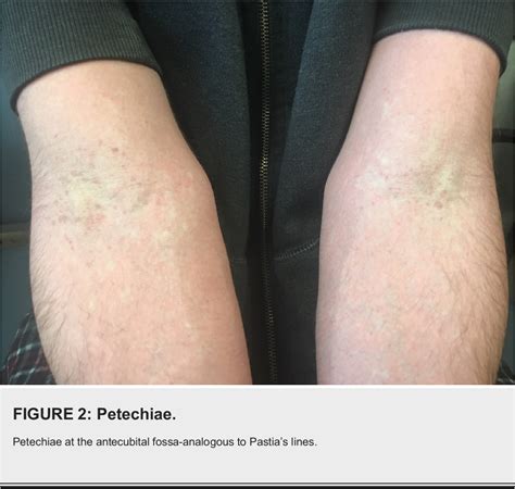 Figure 1 from Scarlatiniform Rash Caused by Mycoplasma pneumoniae ...