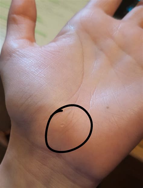 I have two small bumps like this on my hand. They're slightly raised and not itchy or painful ...