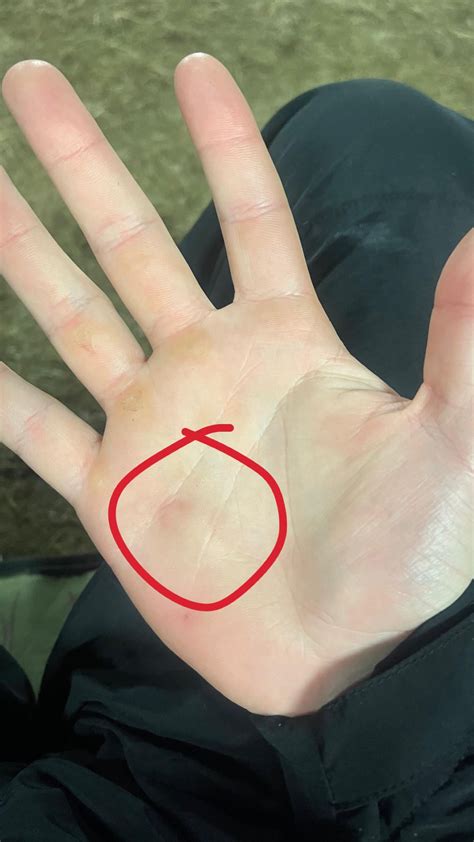 Bruised lump on palm : r/medical
